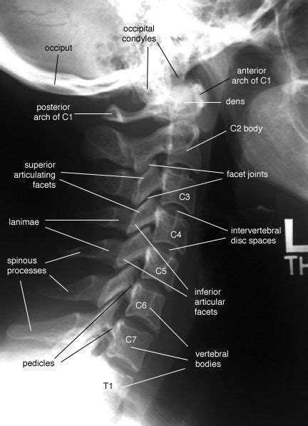 Radiographic Anatomy of the Skeleton: Cervical Spine -- Lateral View, Labelled | Cervical xray ...