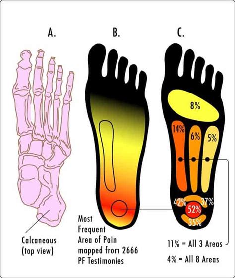 Plantar Fasciitis: A Hiker's Guide to Heel Pain - SectionHiker.com