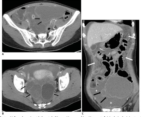 Figure 3 from CT Imaging Findings of Ruptured Ovarian Endometriotic Cysts: Emphasis on the ...