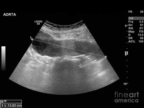 Abdominal Aortic Aneurysm, Ultrasound #1 Photograph by Science Photo Library - Pixels