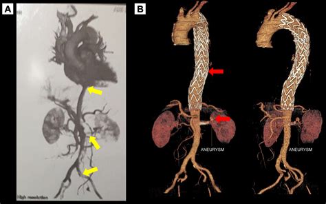 Cureus | Endovascular Approach to Severe Acute Type B Aortic Dissection