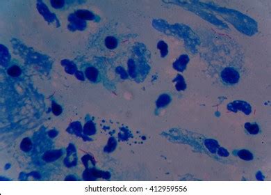 Bacterium Mycobacterium Tuberculosis Under Microscope 100x Stock Photo ...