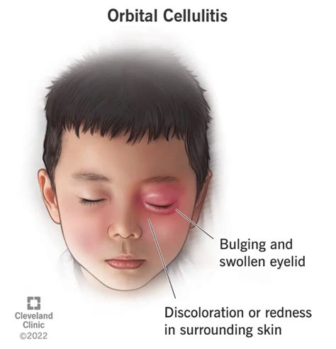 Periorbital Cellulitis Symptoms Causes Treatment – NBKomputer