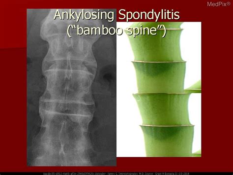 Ankylosing Spondylitis Bamboo Spine