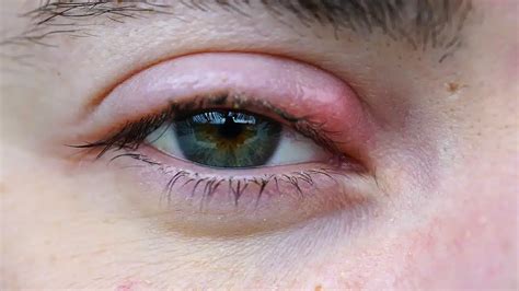 Pink Eye vs Stye: Comparing the Causes, Symptoms, and Remedies