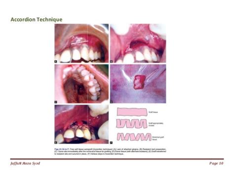 036. mucogingival surgery