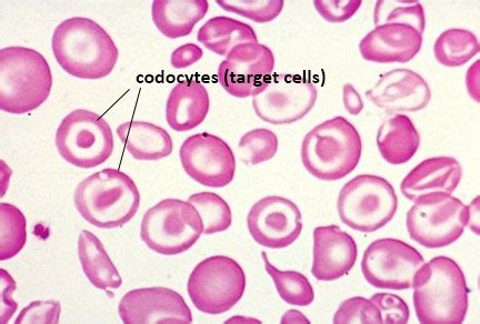 Thalassemias: β-Thalassemias - The Medical Biochemistry Page