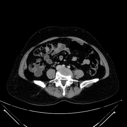 Mesenteric cyst | Image | Radiopaedia.org