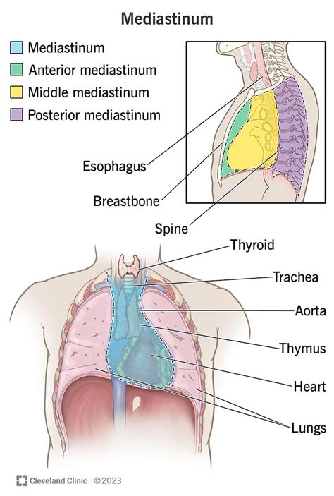 Mediastinal Mass (Tumor): Types, Symptoms, Causes & Treatment