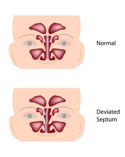 Chronic Sinusitis | Deviated Septum