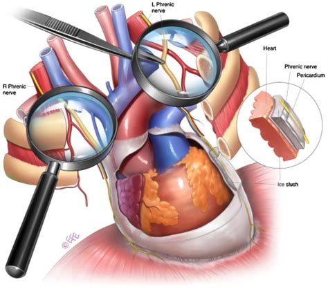 Phrenic Nerve Injury During Cardiac Surgery: Mechanisms, Management and Prevention - Heart, Lung ...