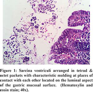 Sarcina Ventriculi of Gastrointestinal Tract: A Clinicopathologic Study