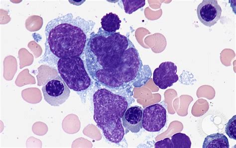 Diffuse large B-cell lymphoma - bone marrow aspirate - 2.