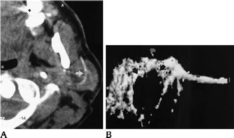 Pleomorphic adenoma. A , Axial CT scan reveals displacement of the main ...