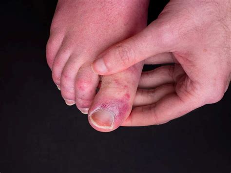 How to Prevent and Treat Chilblains Toes and Fingers - Survival World