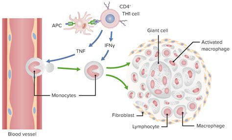 Type IV Hypersensitivity Reaction | Concise Medical Knowledge