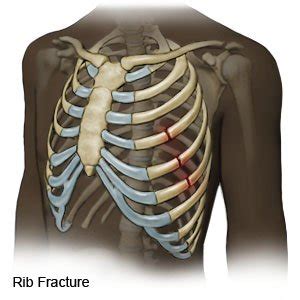 How To Help A Broken Rib - Classeconomy3