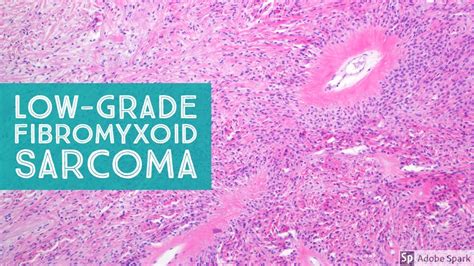 Low-Grade Fibromyxoid Sarcoma (Evans Tumor) 101...Explained by a Sarcoma Pathologist - YouTube