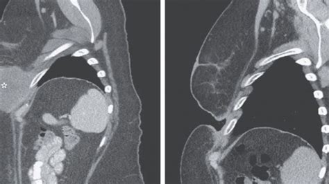 New Cancer Therapy "Dissolves" Woman's Tumor In 3 Weeks | IFLScience