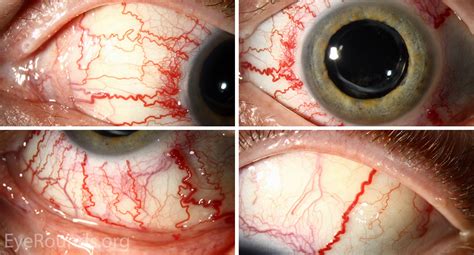 Cavernous Sinus Fistula