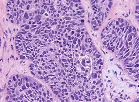 Pathology Outlines - High grade serous carcinoma