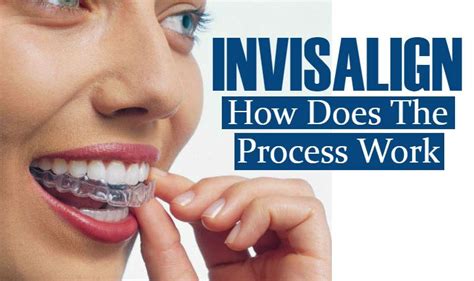 Chino Aesthetic Dental: How Does The Process of Invisalign Work?