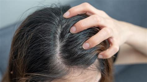 Itchy Scalp and Hair Loss? Dermatologists Reveal the Surprising Cause + How to Speed Regrowth