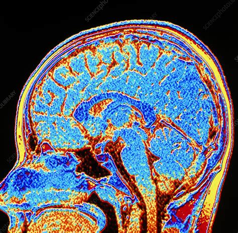 Coloured CT scan of a healthy brain in head - Stock Image - P332/0262 - Science Photo Library