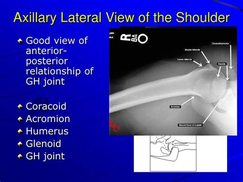 PPT - X-Ray Rounds: (Plain) Radiographic Evaluation of the Shoulder PowerPoint Presentation - ID ...