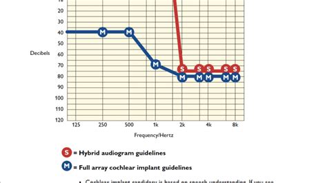 Cochlear Implant and Hybrid Implant Candidacy - Johns Hopkins Medicine