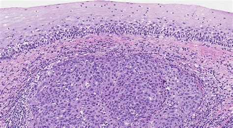 Cervical Carcinoma Histology