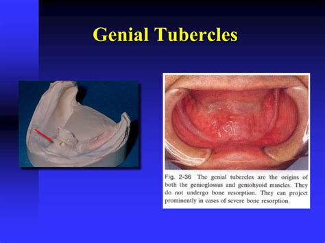 PPT - Anatomy of Mandibular Denture Bearing Area PowerPoint ...