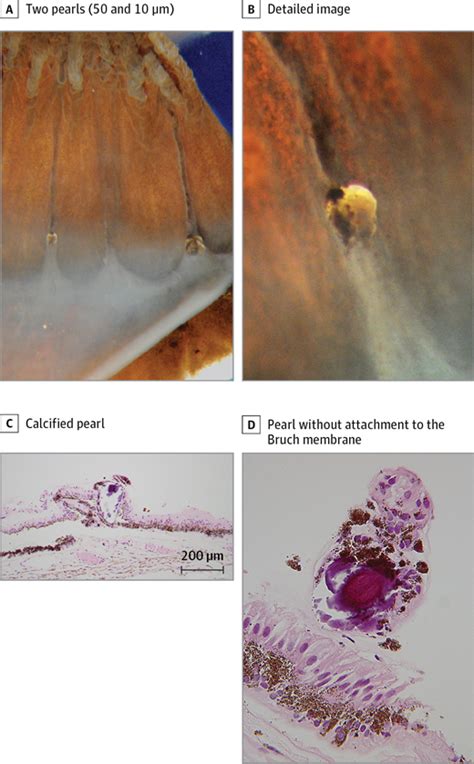 Elemental Composition of Ora Serrata Pearls—A Form of Focal Nodular Drusen | Ophthalmic Imaging ...