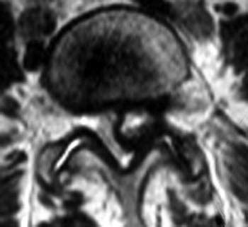 Lumbar Synovial Cyst | Radsource