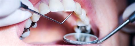 Dental Tooth Decay Treatment In India | Dental Cavity Treatment Near Me