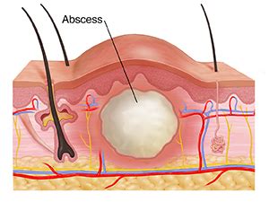 Abscess Drainage | Saint Luke's Health System