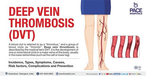 Deep Vein Thrombosis, DVT Symptoms, Causes And, 53% OFF