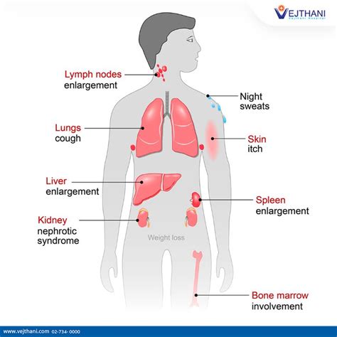 Lymphoma Treatment in Thailand | Vejthani Hospital