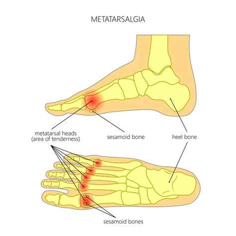 [DIAGRAM] Leg Pain Diagram - MYDIAGRAM.ONLINE