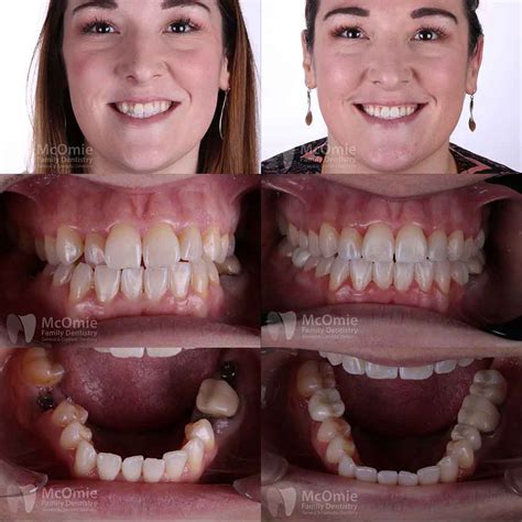 Clear Correct Aligners Patient Before and Afters - McOmie Dentistry ...