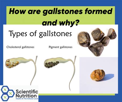 The Impact of Gallstones, Bile, and Minerals on Gallbladder Health