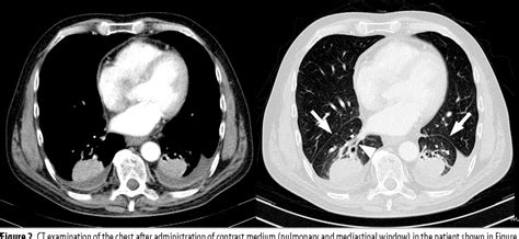 Figure 2 from Rounded atelectasis of the lung: A pictorial review | Semantic Scholar