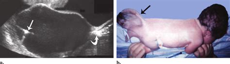 In utero drainage of a large cystic sacrococcygeal teratoma. (a) US ...