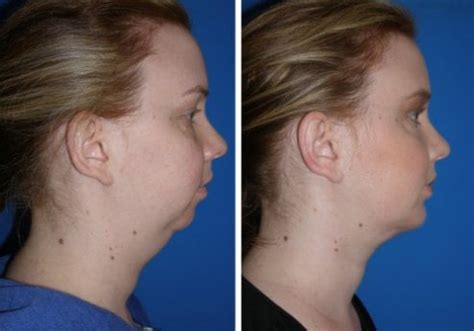 Chin Implant and Liposuction