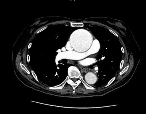 Thoracic Aortic Aneurysm CT