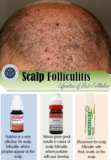 Top Homeopathy Medicines for Scalp Folliculitis and other Scalp Infections