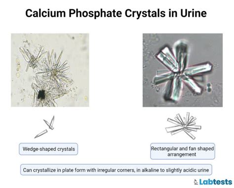 Urinary Crystals: Types, Causes, and Clinical Significance