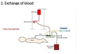 Exchange transfusion