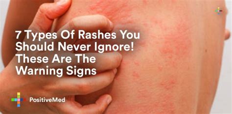 7 Types of Rashes You Should Never Ignore These Are The Warning Signs in 2020 | Types of rashes ...