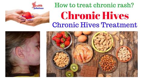 Chronic Hives - Chronic Hives Treatment - How to treat chronic rash ? - YouTube